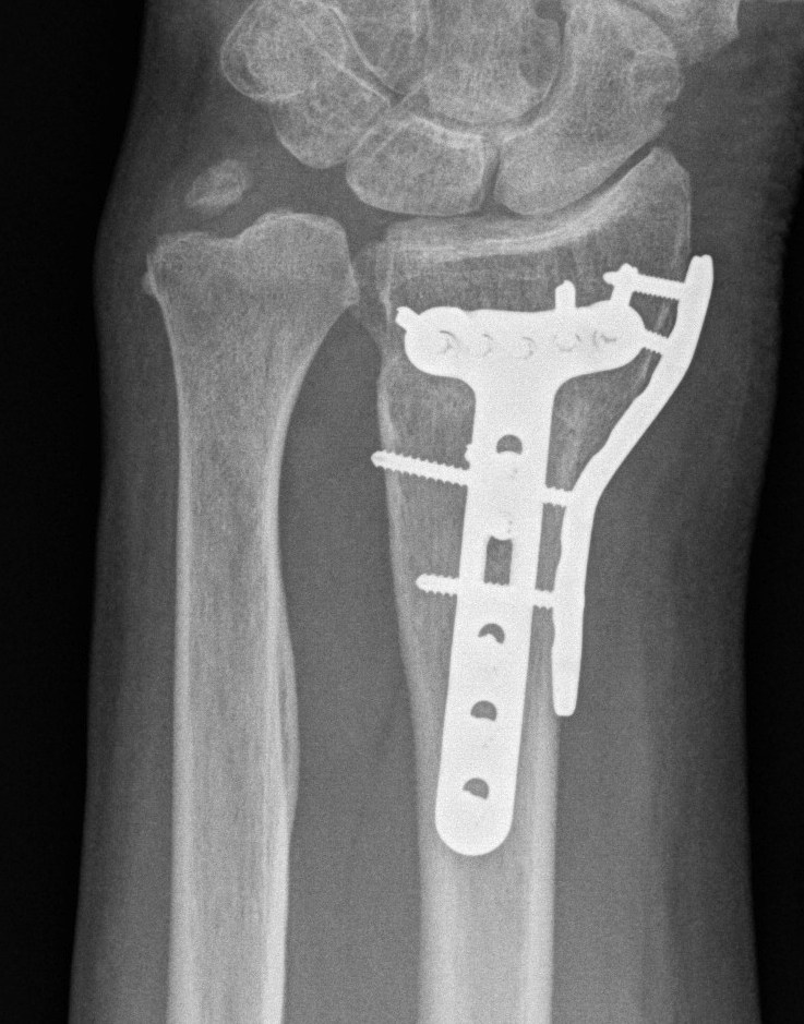 Radial Styoid Plate